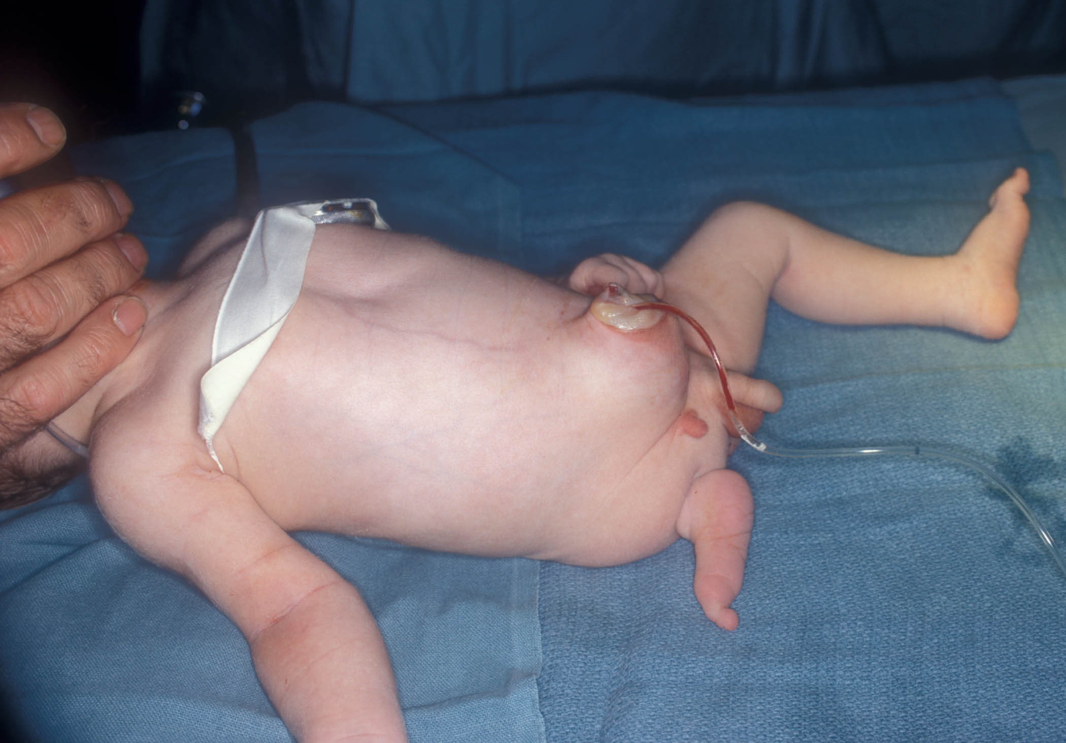 Concept about Gastroschisis | CHAPTER 8 | Pediatric Nursing