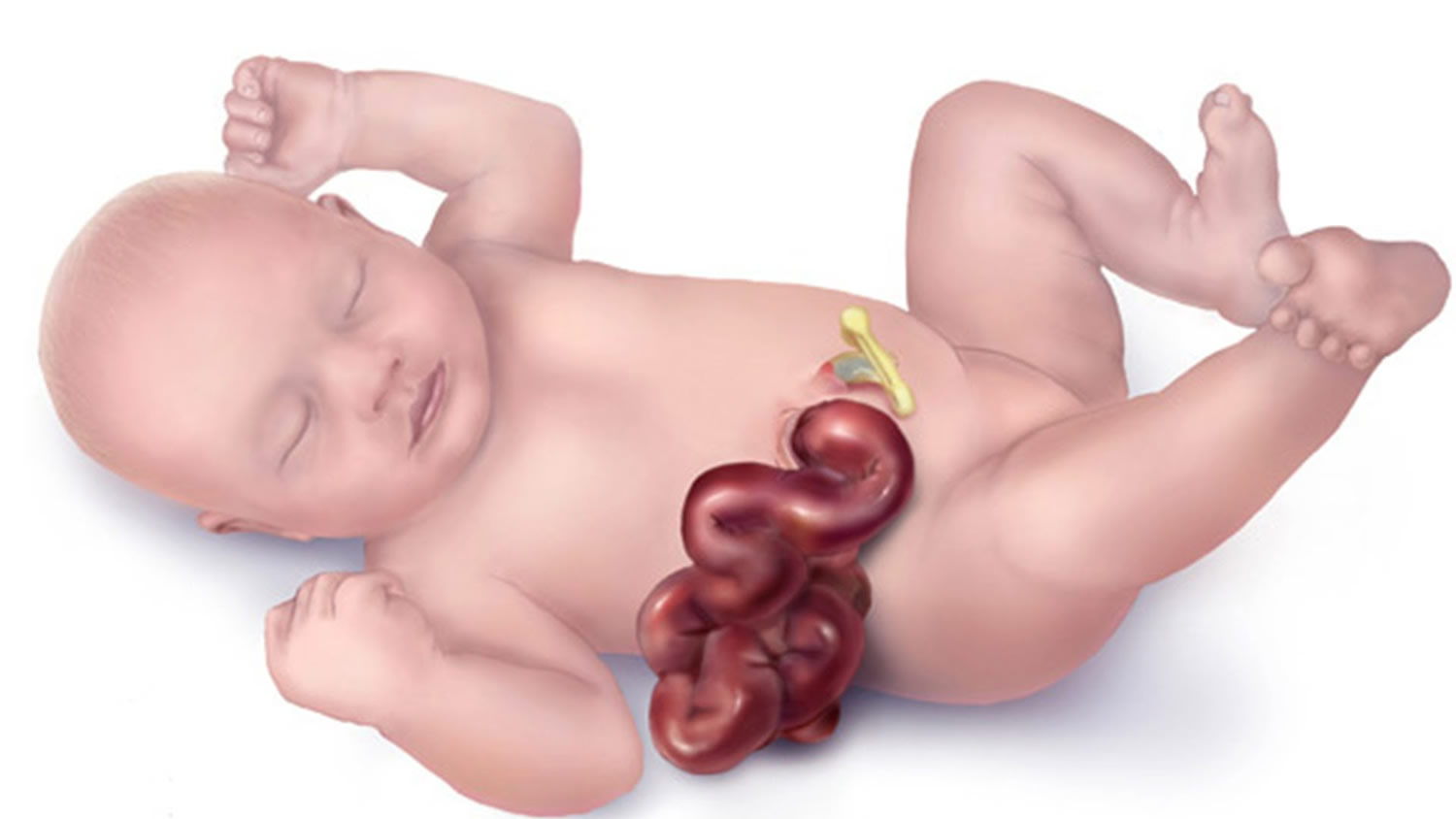 Concept about Gastroschisis | CHAPTER 8 | Pediatric Nursing