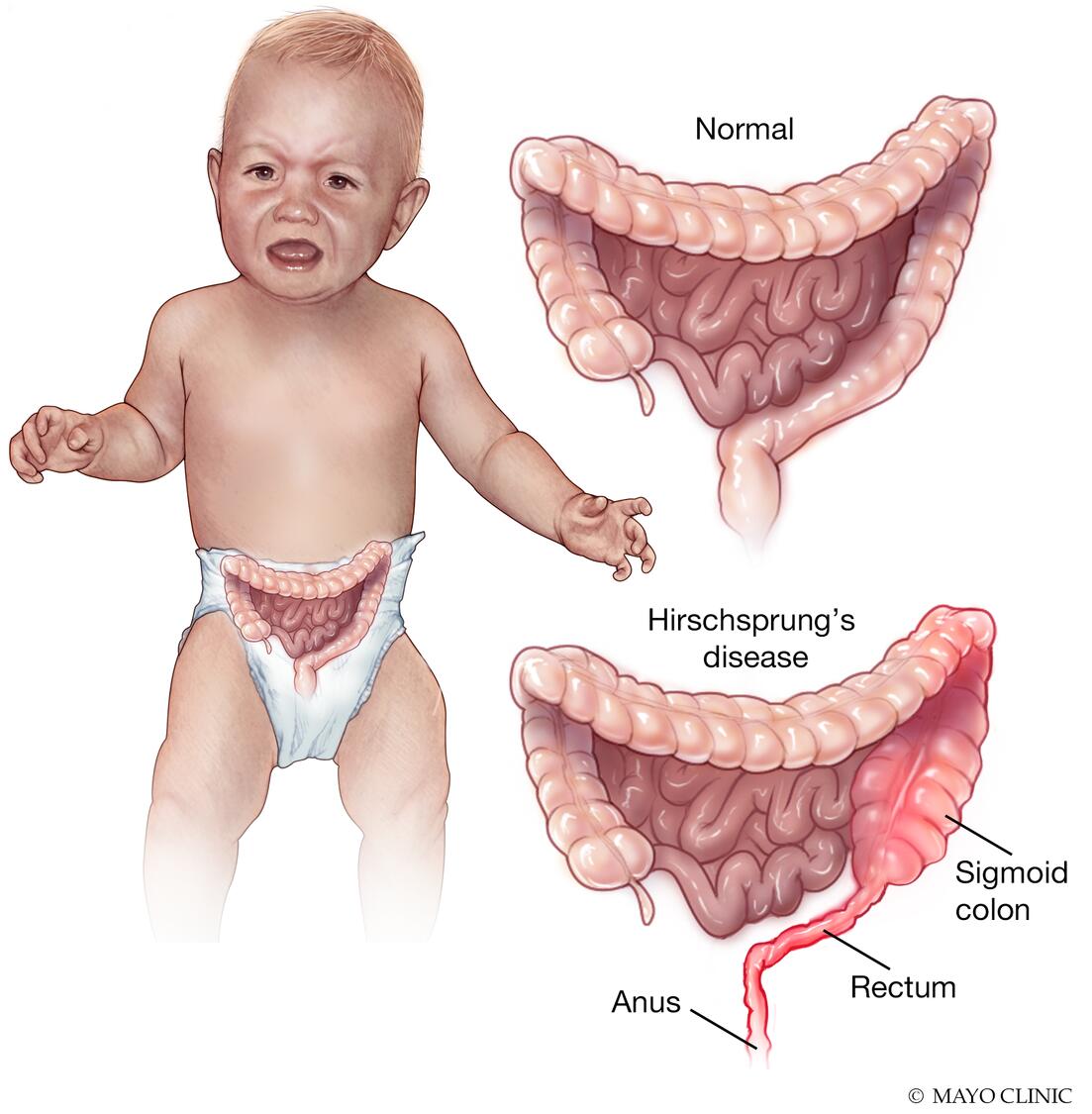 Hirschsprungs disease | CHAPTER 8 | Pediatric Nursing