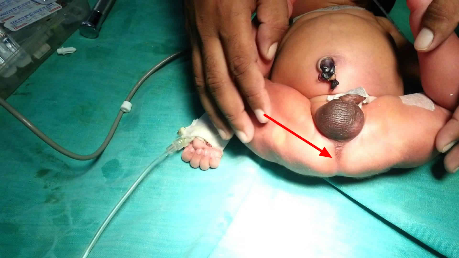 Imperforated Anus/Anorectal Malformations | CHAPTER 8 | Pediatric Nursing
