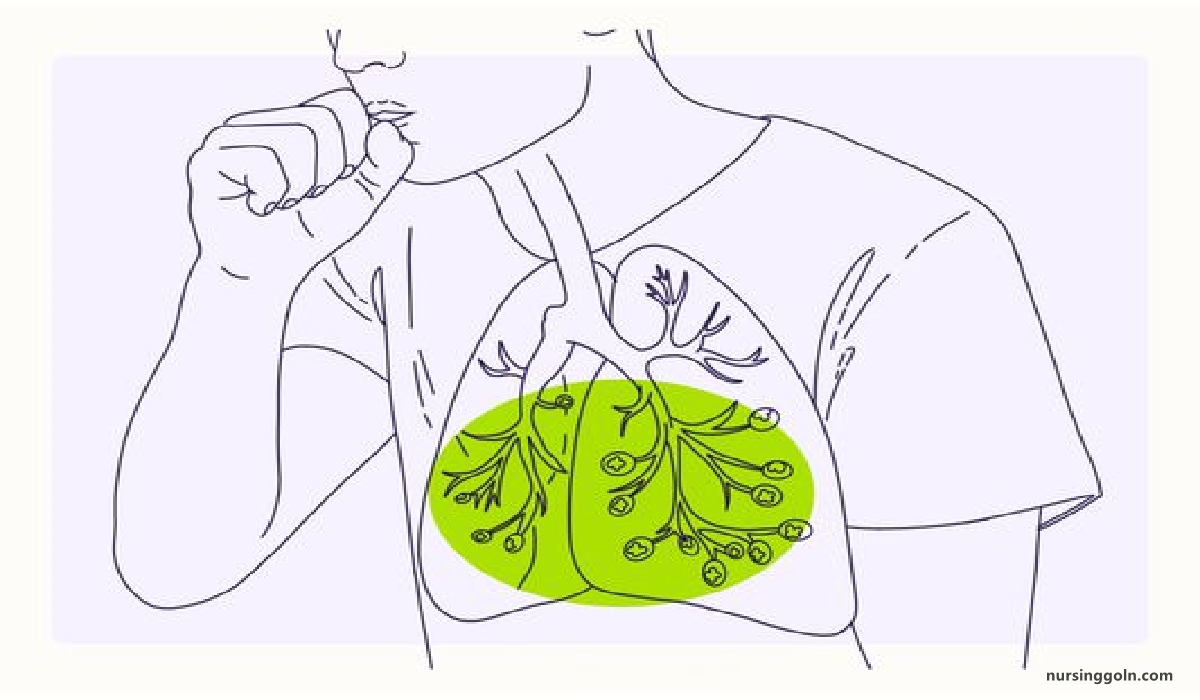Lung cancer | CHAPTER-12 | Medical and Surgical Nursing