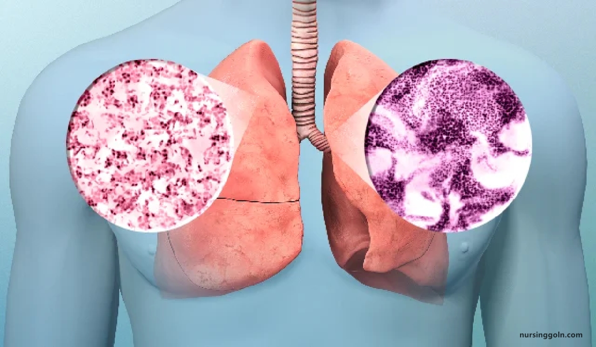 Lung cancer | CHAPTER-12 | Medical and Surgical Nursing