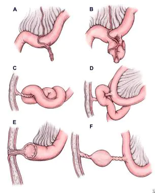 Meckels diverticulum | CHAPTER 8 | Pediatric Nursing