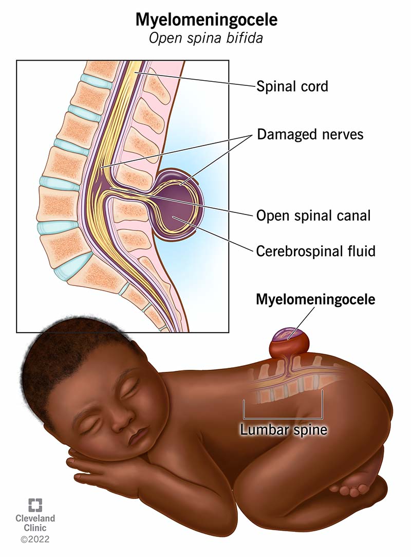 Meningocele or Myelomeningocele | CHAPTER 8 | Pediatric Nursing