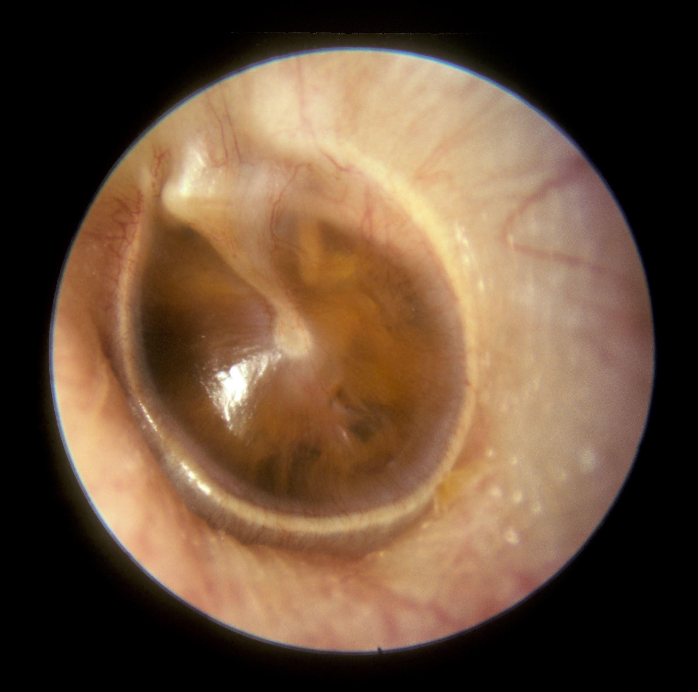 Otitis media | CHAPTER 6 | Pediatric Nursing