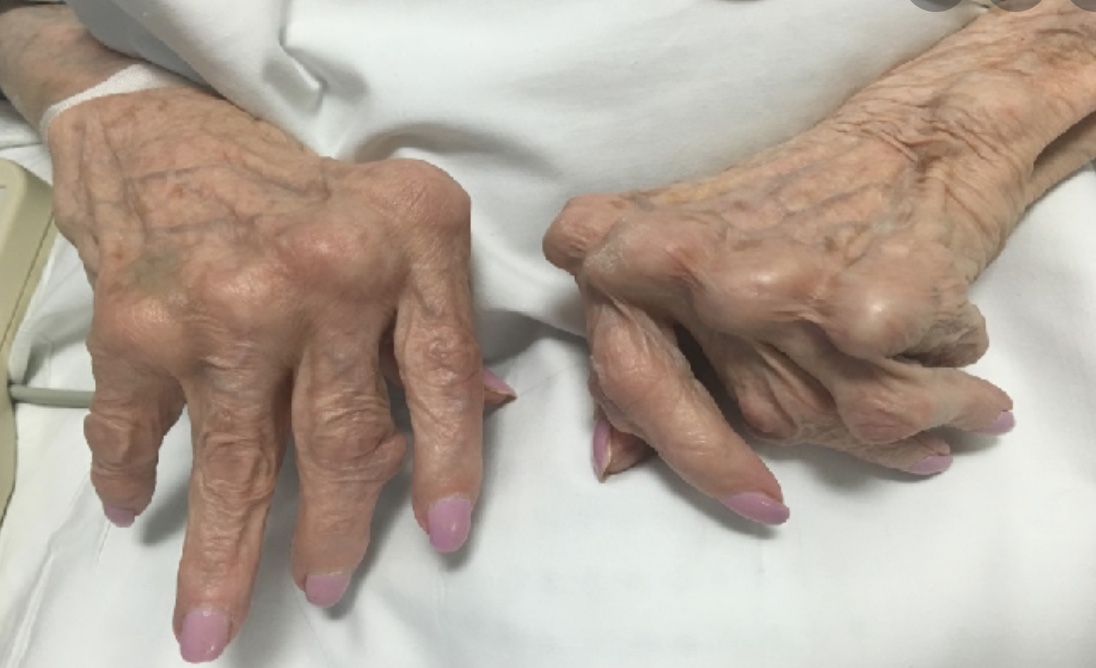 Rheumatoid Arthritis | CHAPTER 12 | Orthopedic Nursing