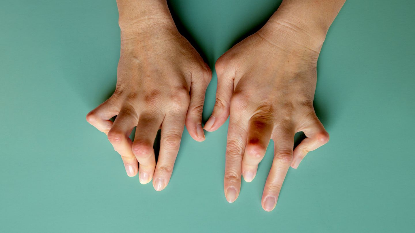 Rheumatoid Arthritis | CHAPTER 12 | Orthopedic Nursing