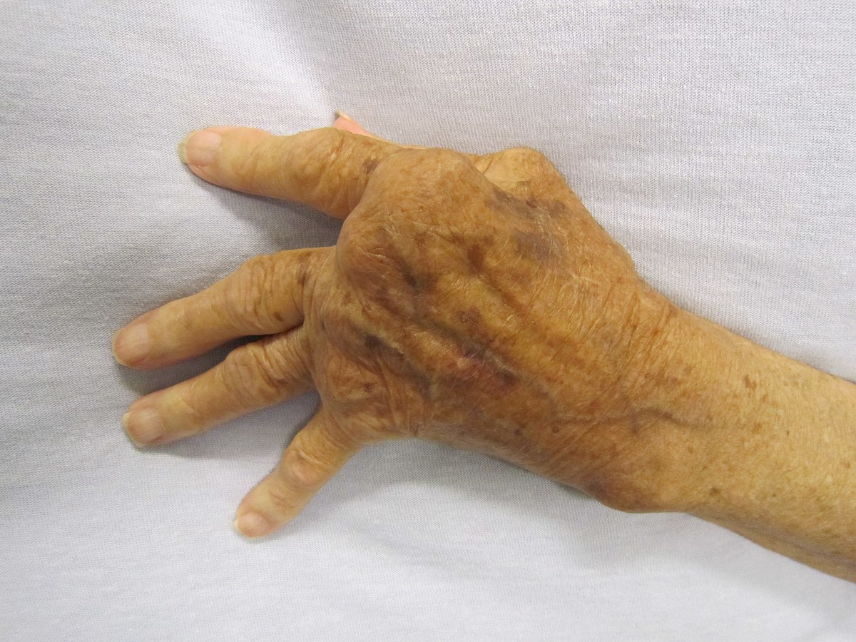 Rheumatoid Arthritis | CHAPTER 12 | Orthopedic Nursing
