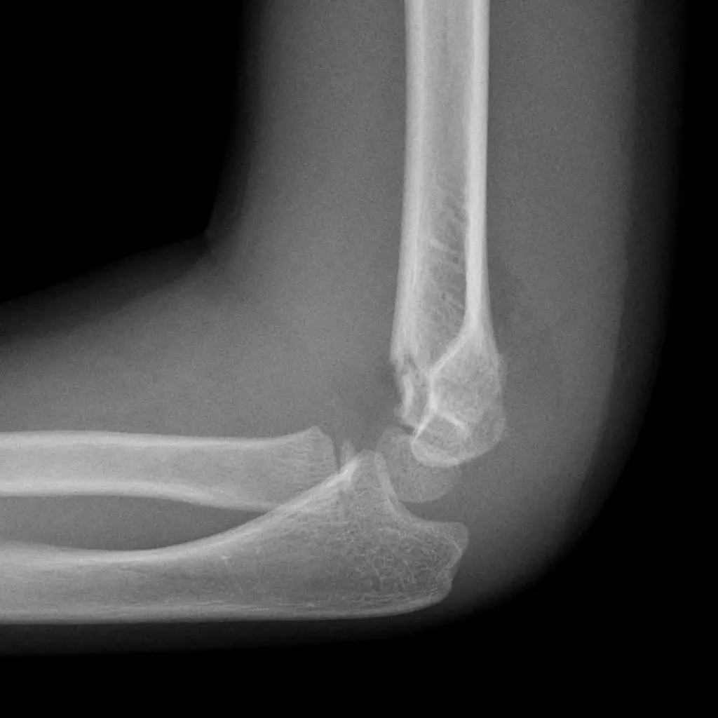 Shaft of Humarus fracture | CHAPTER 5 | Orthopedic Nursing