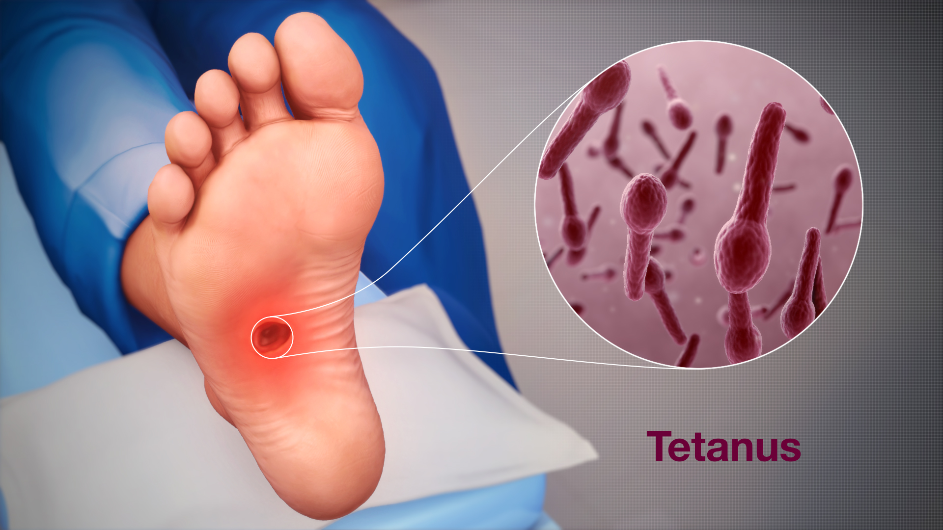 Definition of Tetanus | CHAPTER 6 | Pediatric Nursing
