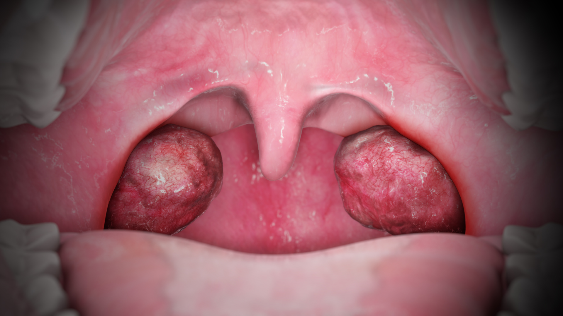 Definition of Tonsillitis | CHAPTER 6 | Pediatric Nursing