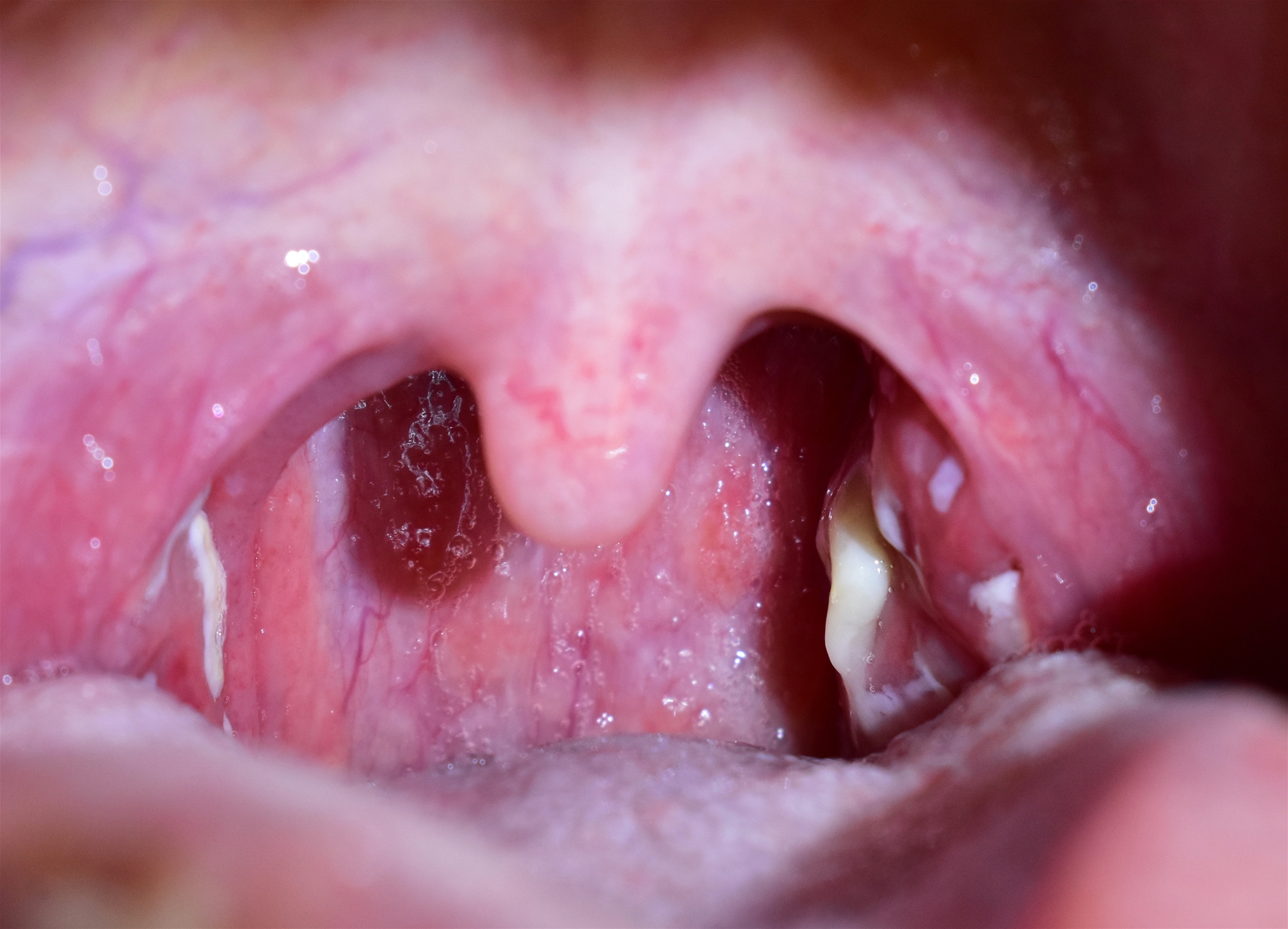 Definition of Tonsillitis | CHAPTER 6 | Pediatric Nursing