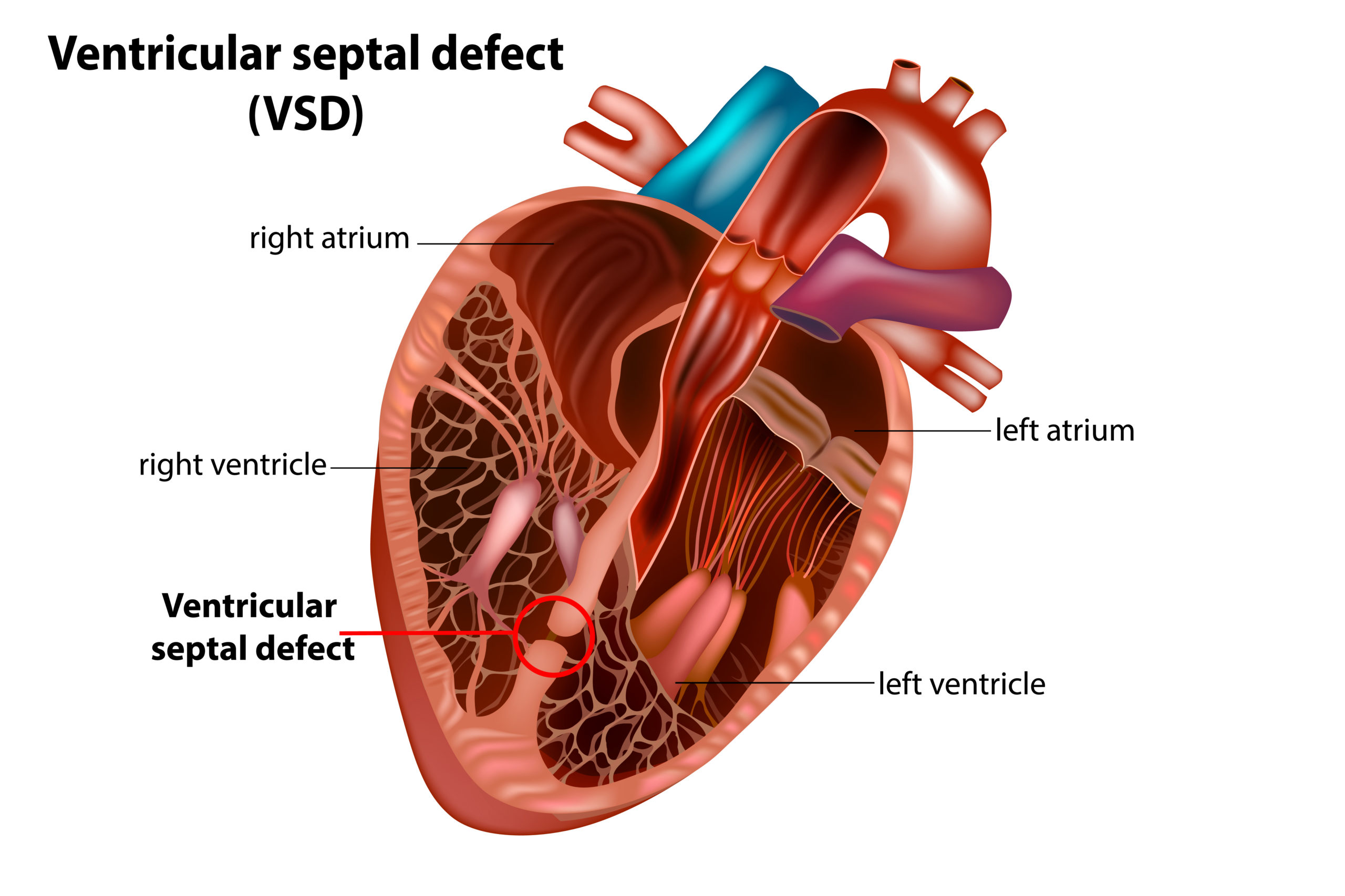 Ventricular septal defect (VSD) | CHAPTER 10 | Pediatric Nursing