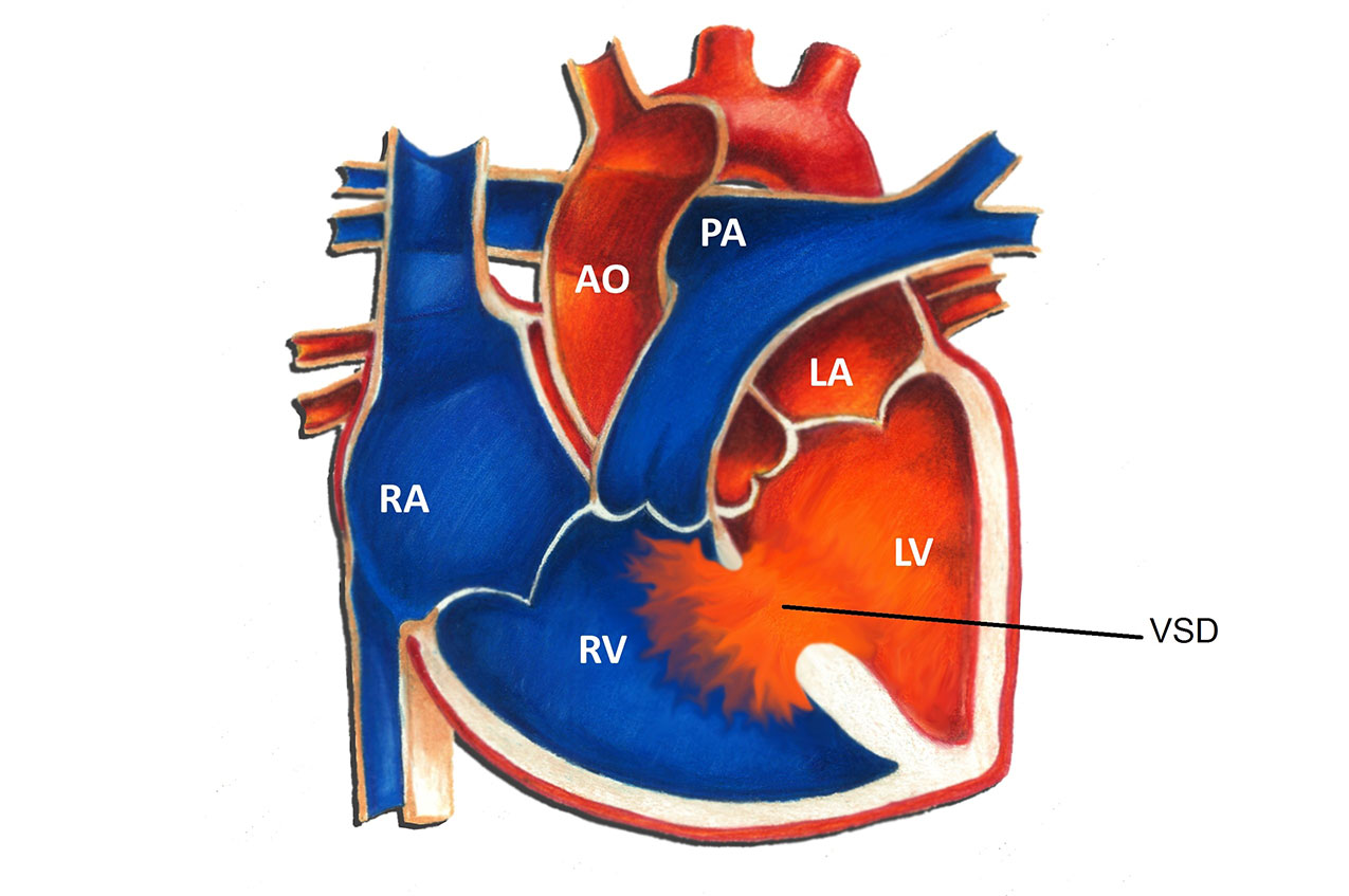 Ventricular septal defect (VSD) | CHAPTER 10 | Pediatric Nursing
