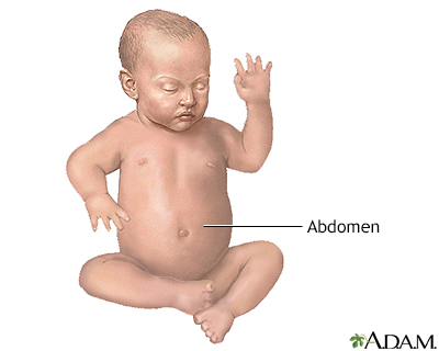 Omphalocele or Exomphalos | CHAPTER 8 | Pediatric Nursing