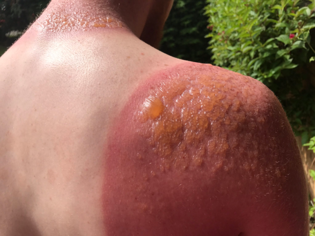 2nd Degree Burn