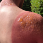 2nd Degree Burn