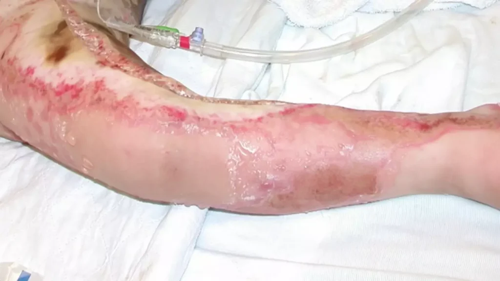 3rd Degree Burn