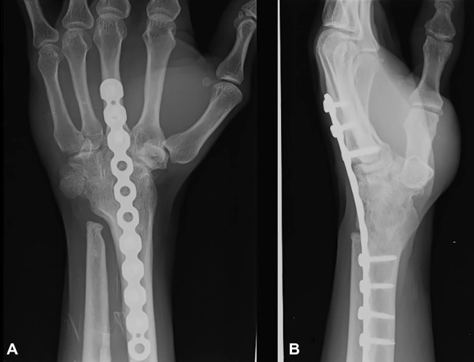 Arthrodesis of wrist joint | CHAPTER 10 | Orthopedic Nursing