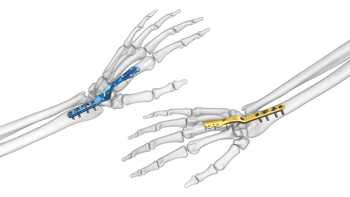 Arthrodesis of wrist joint | CHAPTER 10 | Orthopedic Nursing
