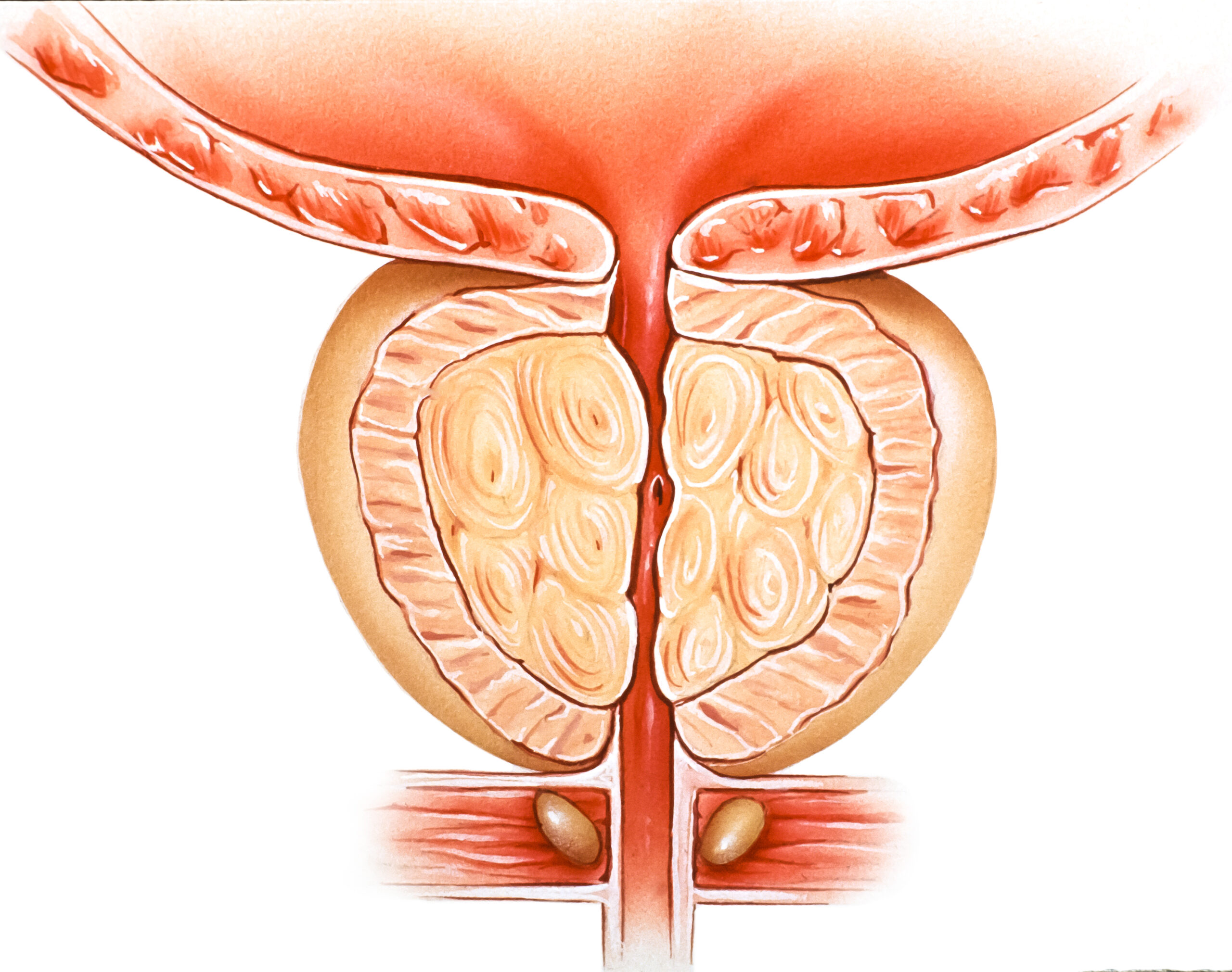 Benign Enlargement of Prostate (BEP)/(BPH) | Chapter 7 | Medical And Surgical Nursing