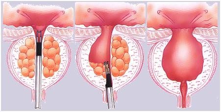 Benign Enlargement of Prostate (BEP)/(BPH) | Chapter 7 | Medical And Surgical Nursing