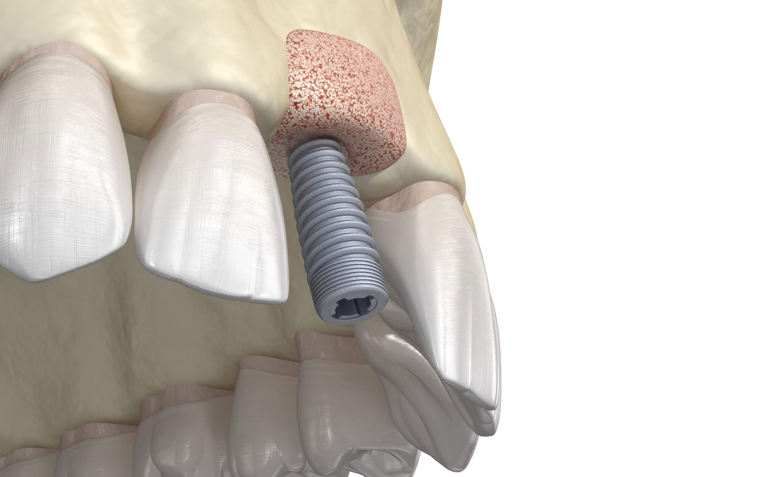Bone Grafting | CHAPTER 7 | Orthopedic Nursing