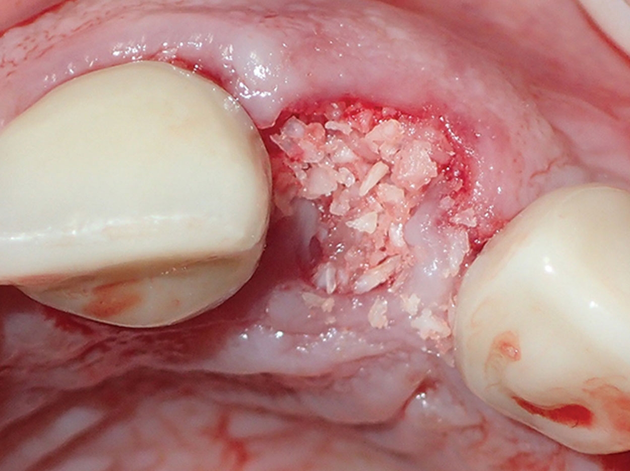 Bone Grafting | CHAPTER 7 | Orthopedic Nursing