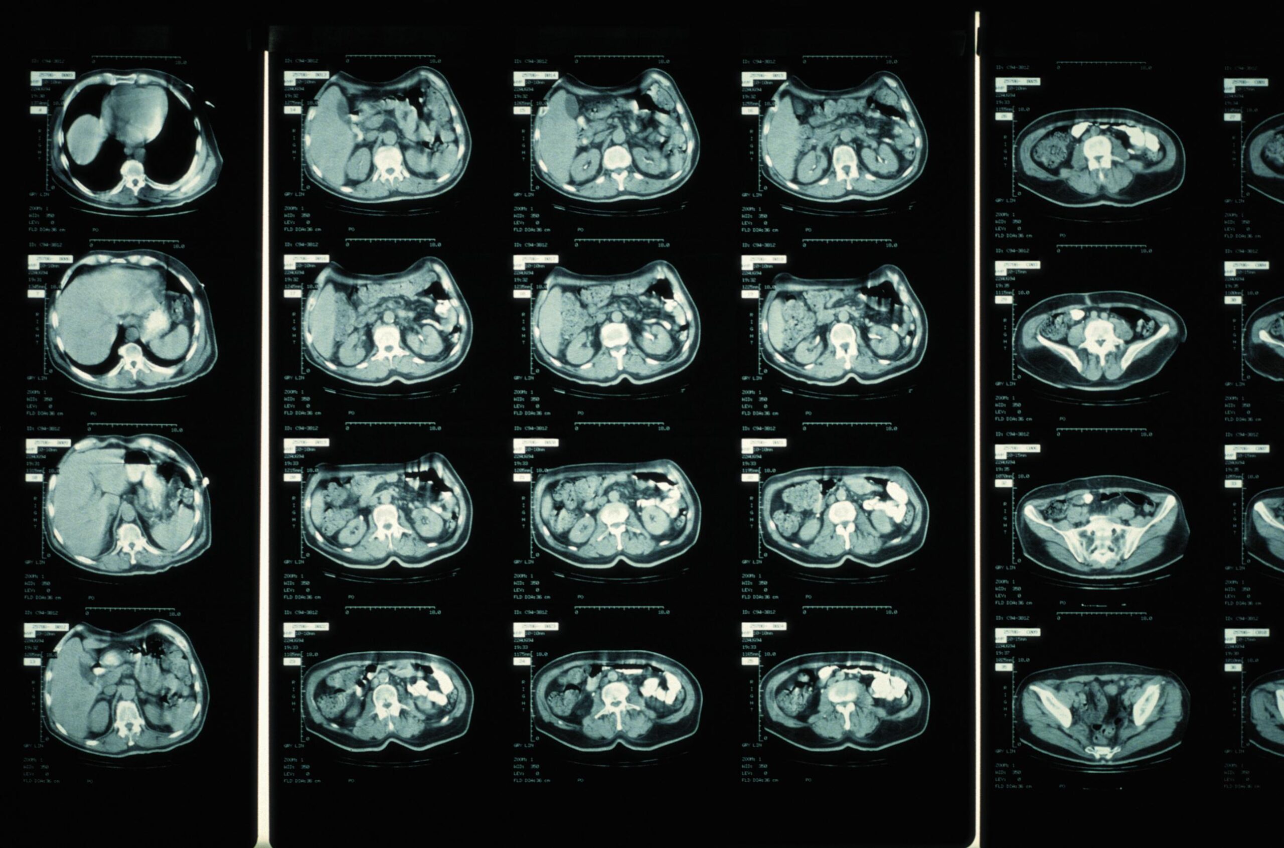 Concept about Ewing's sarcoma | CHAPTER 16 | Orthopedic Nursing