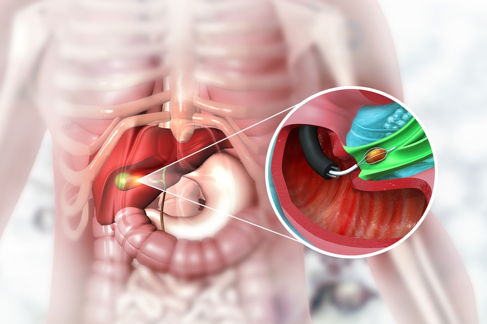 Concept About Cholecystitis | CHAPTER-6 | Medical and Surgical Nursing