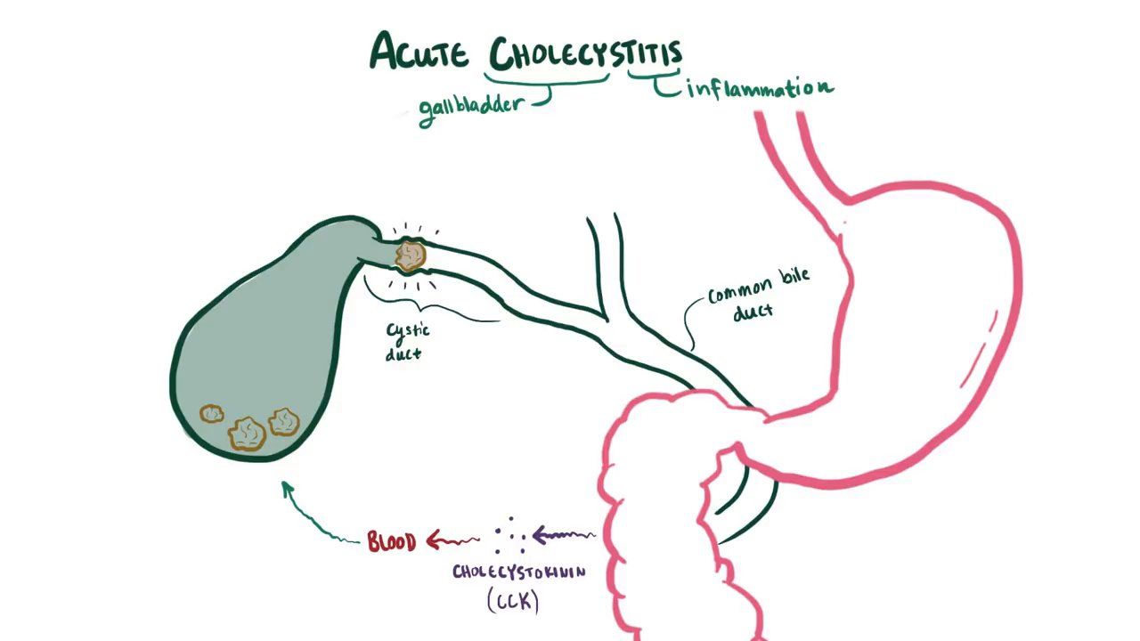 Concept About Cholecystitis | CHAPTER-6 | Medical and Surgical Nursing