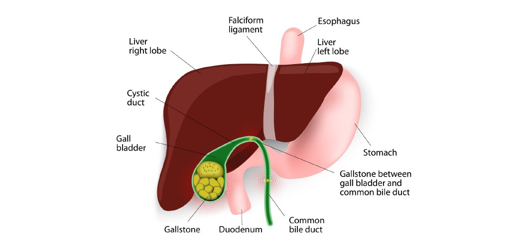 Definition of Cholelithiasis | CHAPTER-6 | Medical and Surgical Nursing