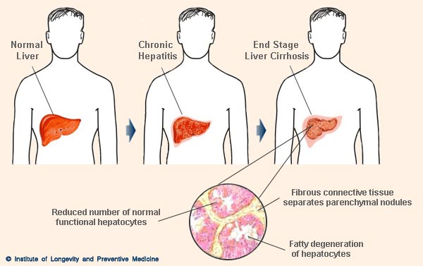 Cirrhosis of liver