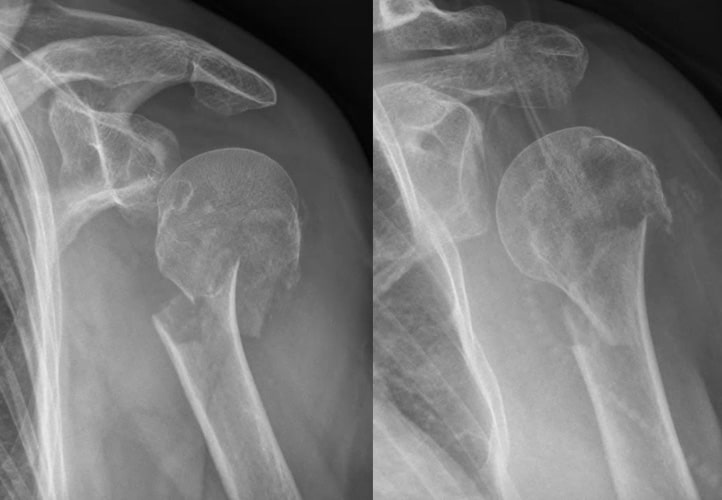 Fracture of Humerus | CHAPTER 5 | Orthopedic Nursing
