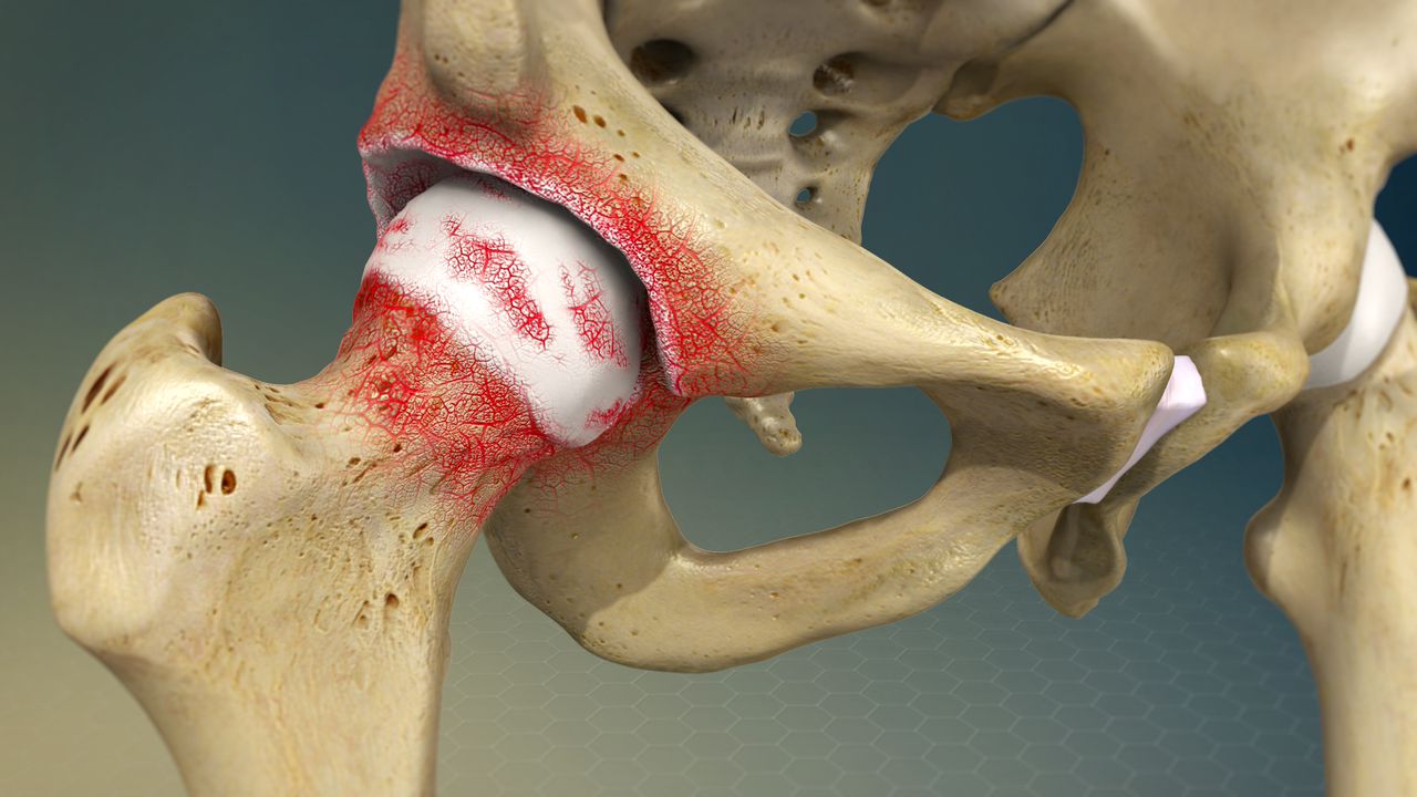 Concept about Osteoarthritis | CHAPTER 13 | Orthopedic Nursing