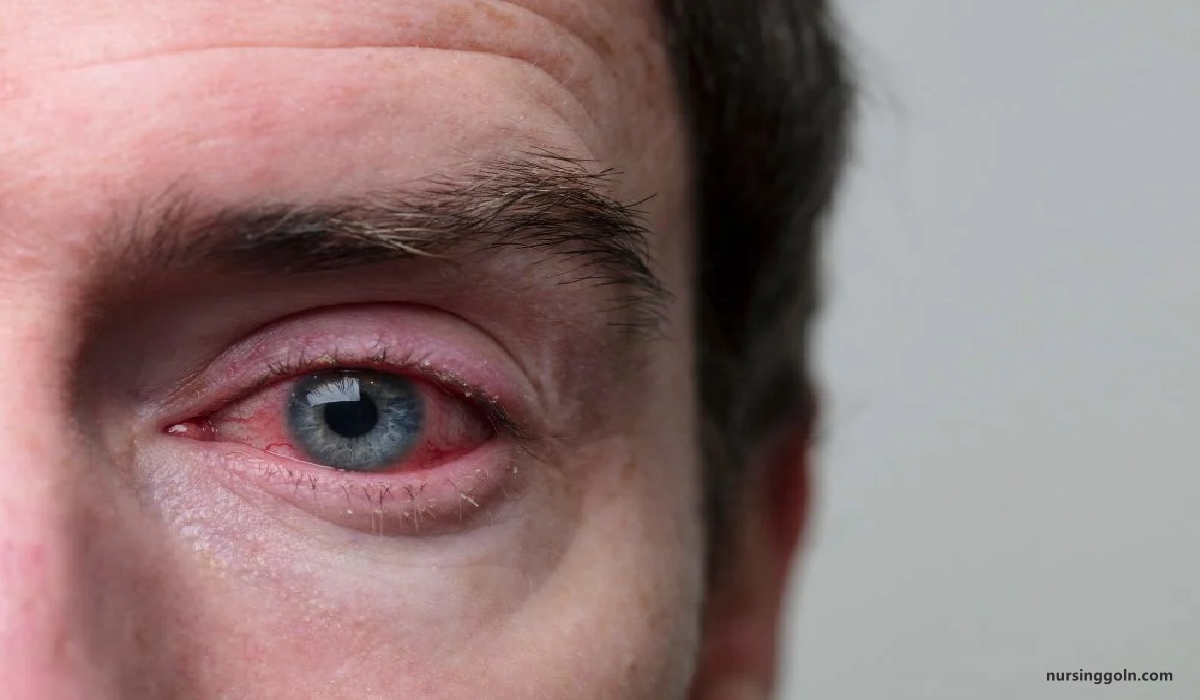 Definition of Conjunctivitis