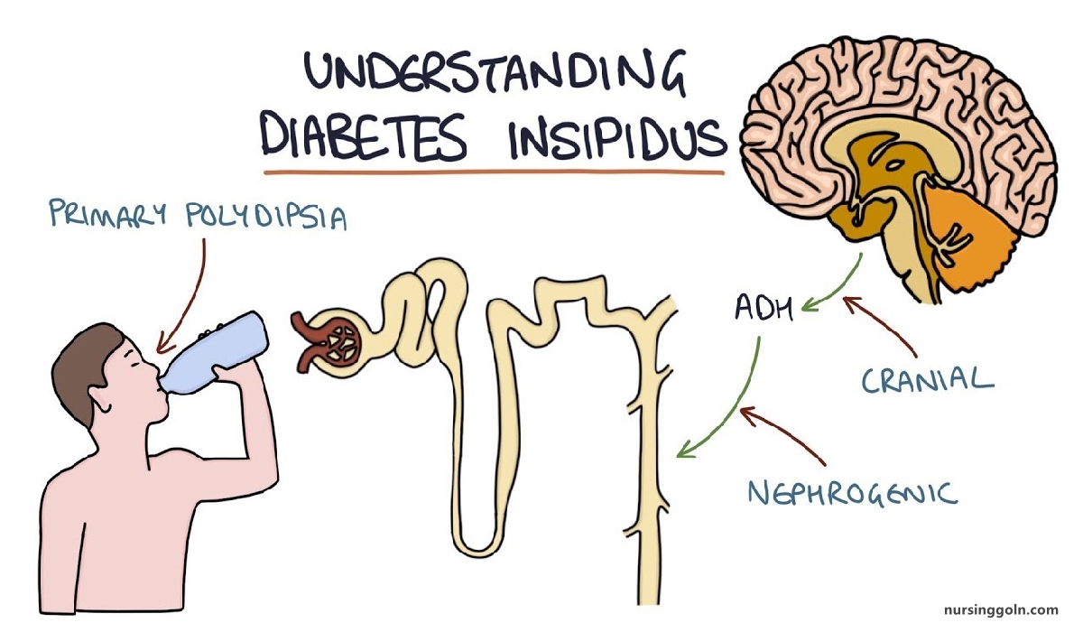 Diabetes Insipidus | CHAPTER-15 | Medical and Surgical Nursing