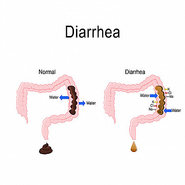 Definition of Diarrhea
