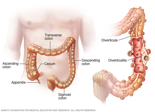 Diverticular disease