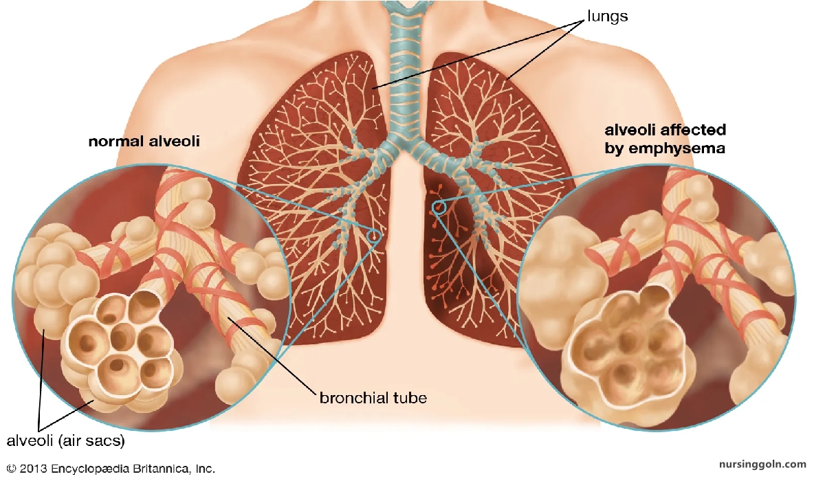 Definition of Emphysema