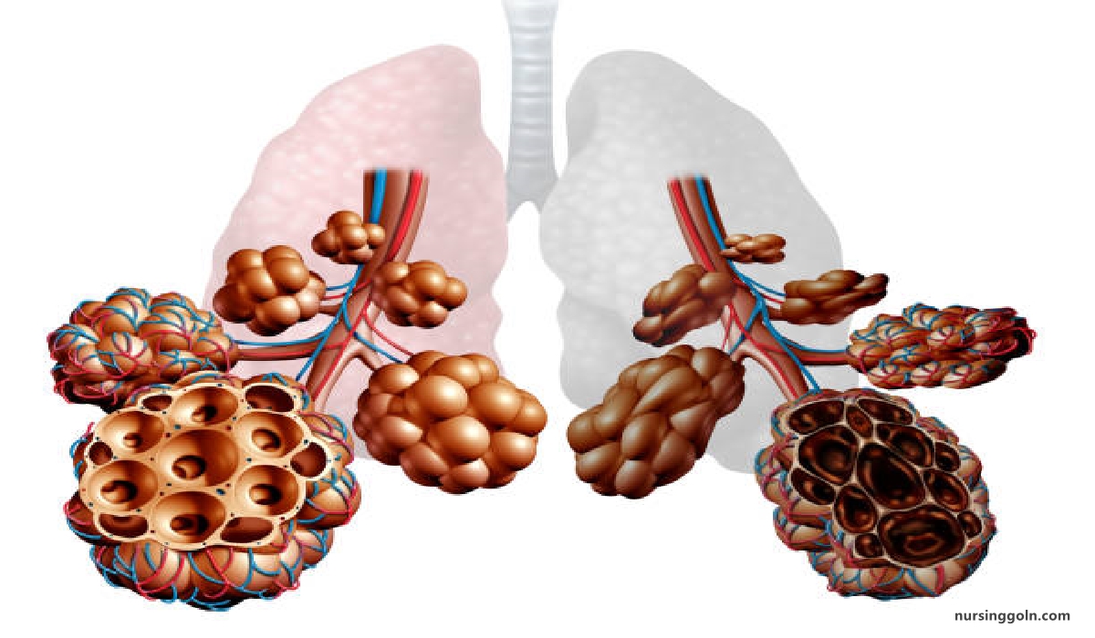 Definition of Emphysema