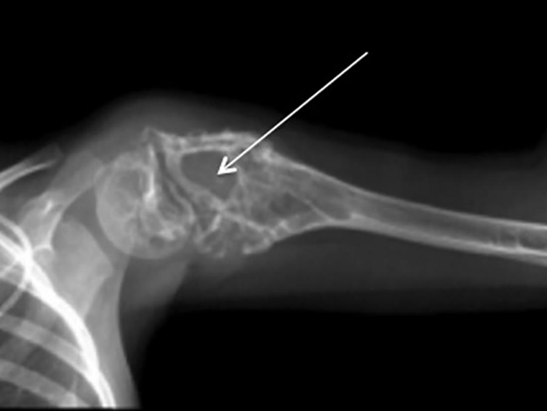 Concept about Ewing's sarcoma | CHAPTER 16 | Orthopedic Nursing