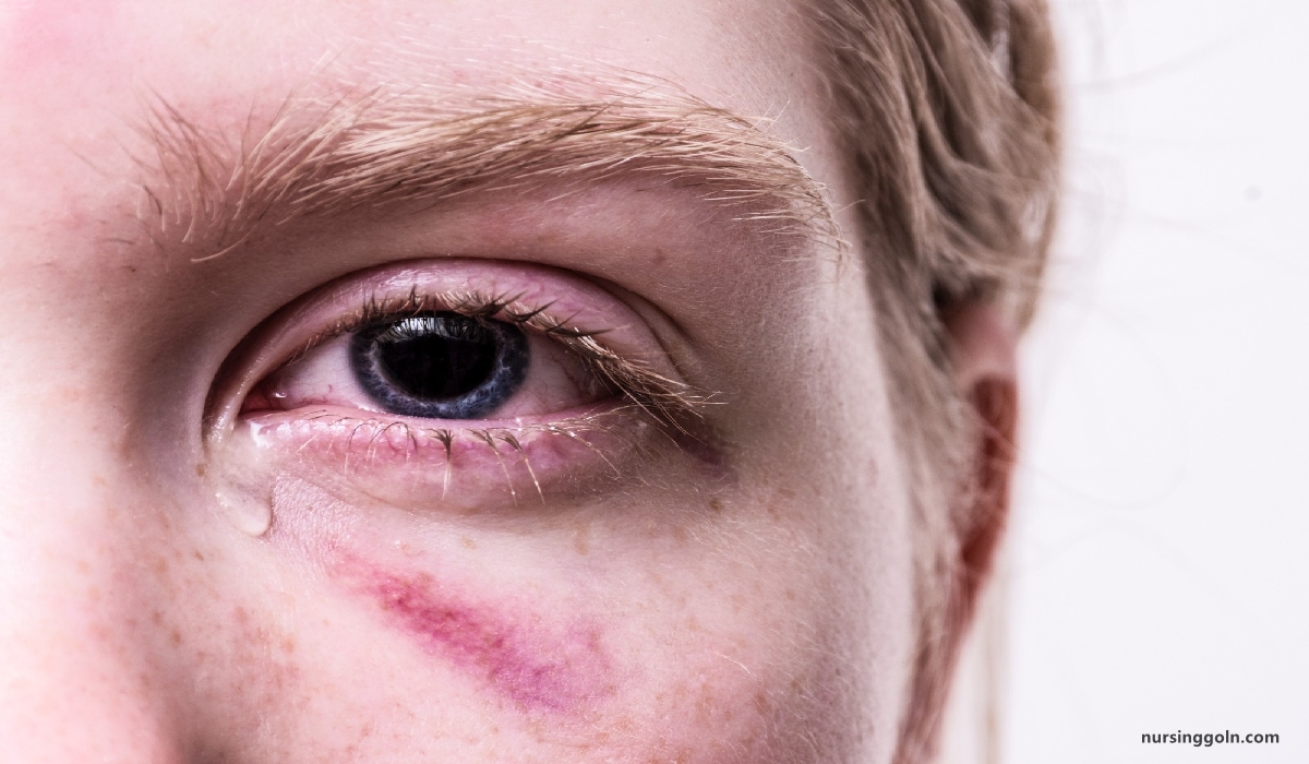 Eye injury | CHAPTER-10 | Medical and Surgical Nursing