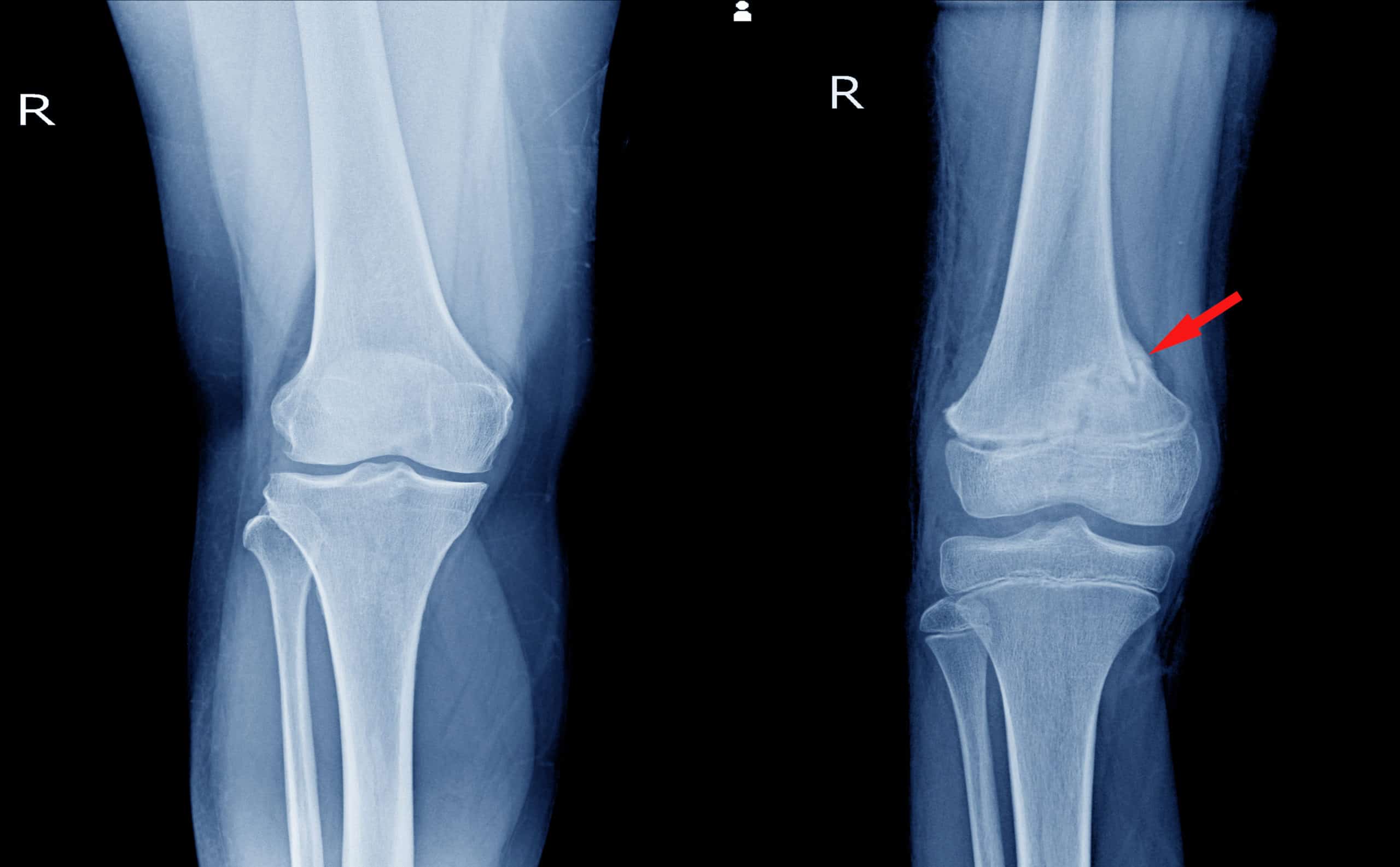 Fracture of Femur