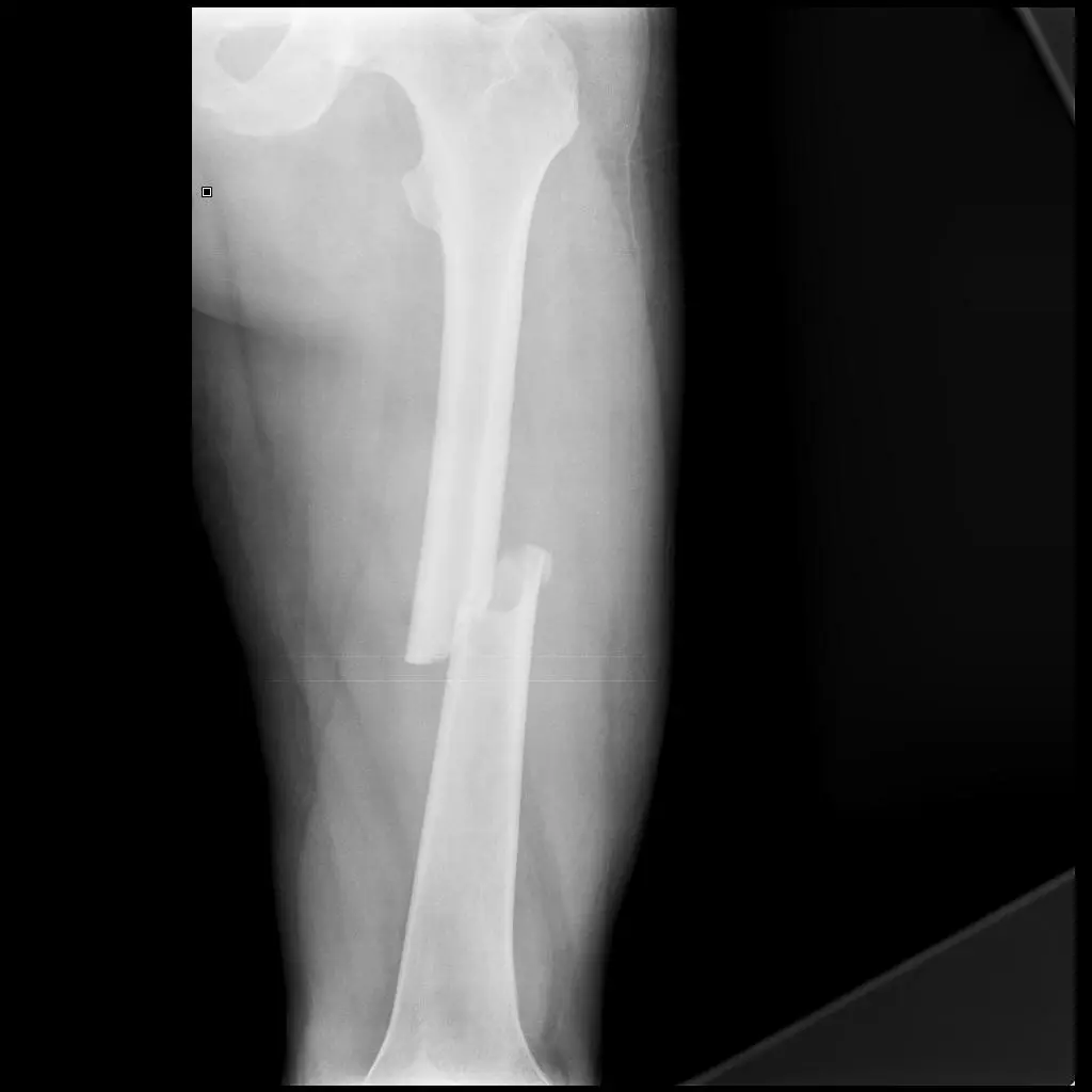 Fracture of Femur