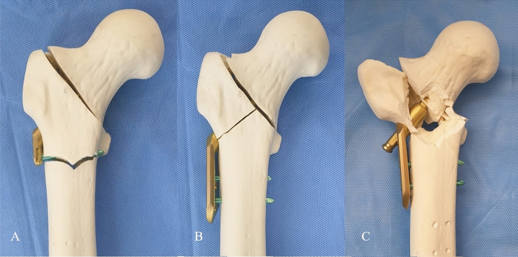 Fracture of Neck of Femur (NOF) | CHAPTER 5 | Orthopedic Nursing