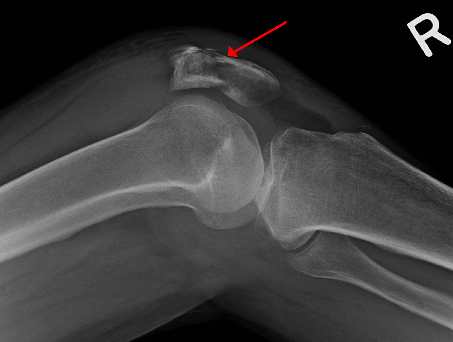 Fracture of Patella | CHAPTER 5 | Orthopedic Nursing