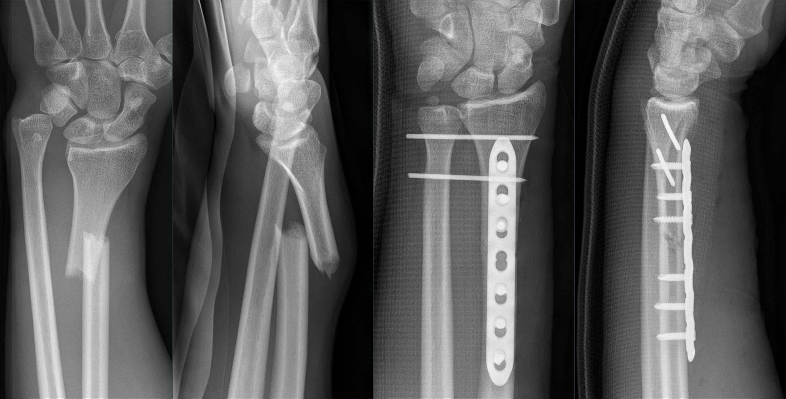 Fracture of radius & Ulna | CHAPTER 5 | Orthopedic Nursing