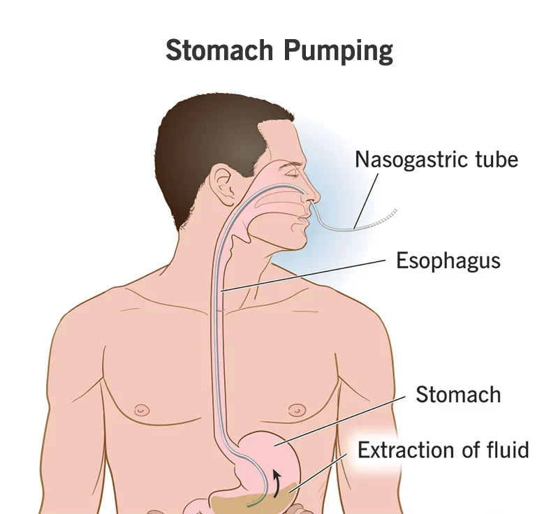 Gastric lavage | CHAPTER-6 | Medical and Surgical Nursing
