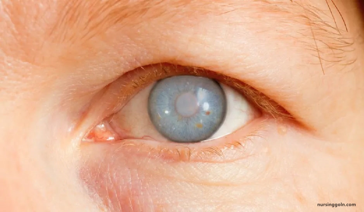 Definition of Glaucoma | CHAPTER-10 | Medical and Surgical Nursing